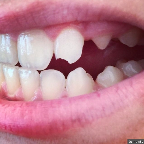 A chip in your teeth, no matter how small, is super vulnerable to tooth decay.
