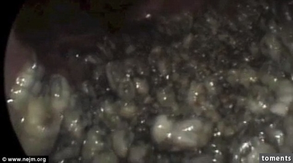 The man came to hospital complaining he had seen what appeared to be worms emerging from his nose. It turned out had more than a hundred maggots buried in his sinuses (pictured)