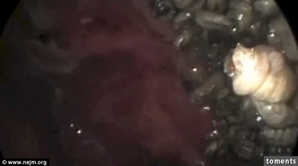 It took four days to clear the maggot infestation as doctors removed them individually, guided by a camera