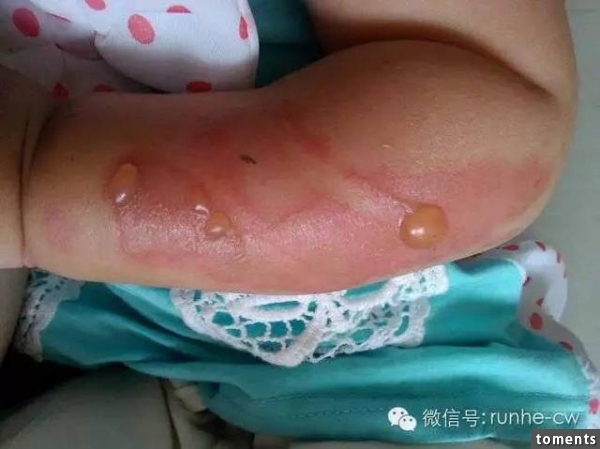 媽媽狠心故意讓孩子被燙傷，沒想到結果卻出人意料
