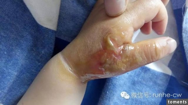媽媽狠心故意讓孩子被燙傷，沒想到結果卻出人意料