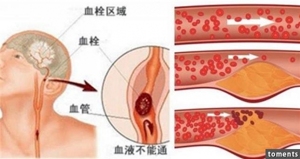 “腦中風”前會有6 個徵兆！ 下一秒可能就天人永隔...為了家人，你一定要知道！