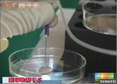 囧！這名丈夫竟把自己妻子的人工受孕全程曝光...！當太太看到這些畫面後瞬間就崩潰了！
