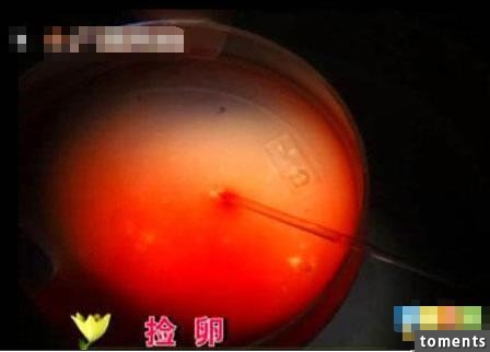 囧！這名丈夫竟把自己妻子的人工受孕全程曝光...！當太太看到這些畫面後瞬間就崩潰了！