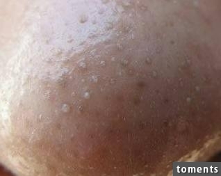 4大招讓黑頭永遠消失!毛孔變小了!粉刺痘痘通通不見了!太棒了一定要學起來!