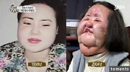 嚇!14個女人整形失敗案例,尤其第8個,完全毀了我童年記憶!!