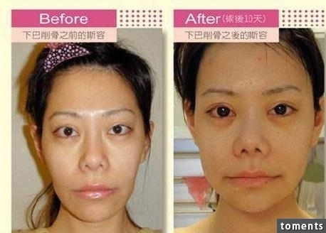 嚇!14個女人整形失敗案例,尤其第8個,完全毀了我童年記憶!!
