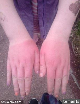 10歲女孩摸了這種草後居然毀容，才幾個小時手就開始紅腫起水泡