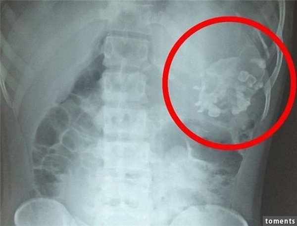 慎入！ 男子胃超痛就醫，醫生竟挖出他的雙生弟弟…不隻長了頭髮，而且還活著！ ！