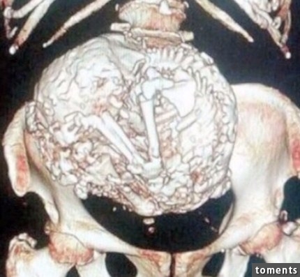 After ordering another X-ray, the doctors discovered that the mass wasn't a tumor, but a fetus. The doctors also determined that Meléndez has had the fetus in her uterus for over six decades.