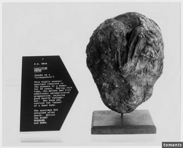 This is probably due to a phenomenon known as lithopedion, in which a fetus dies during pregnancy and calcifies because it's too large to be absorbed by the body. Once calcified, the fetus poses no immediate risk to the mother.