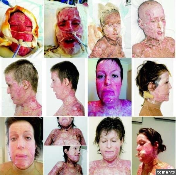 戴娜被严重烧伤,身上的灼伤面积达到了64%,整个人面目全非.